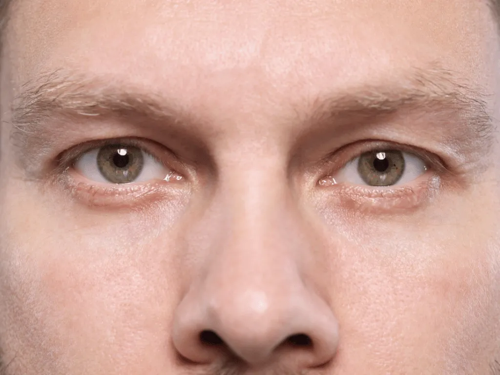 Undichte Augenbrauen Augenbrauentransplantation - Dion Hair Clinic
