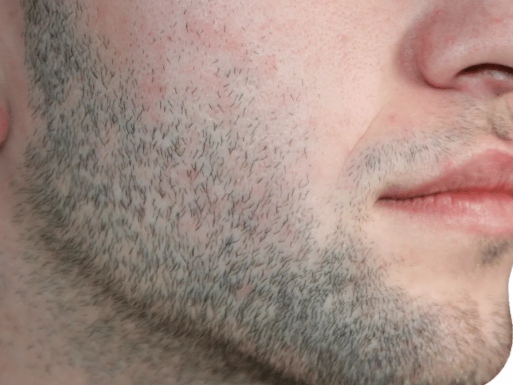 Bartkontur Barttransplantation Muster - Dion Hair Clinic