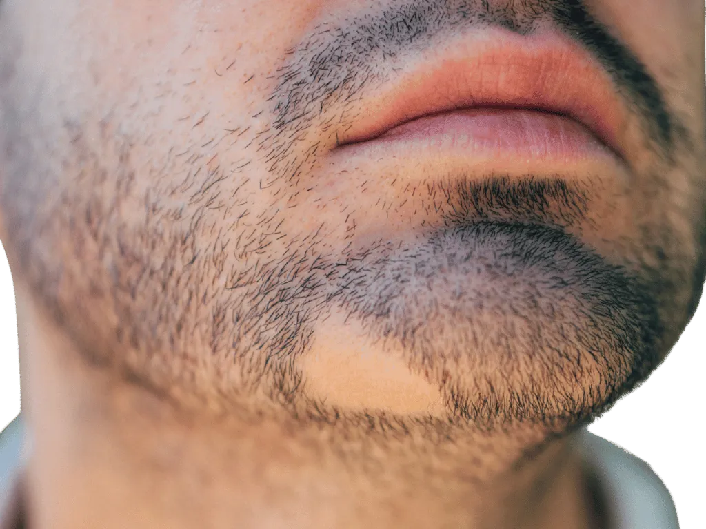 Bart mit Lücken Barttransplantation Muster - Dion Hair Clinic
